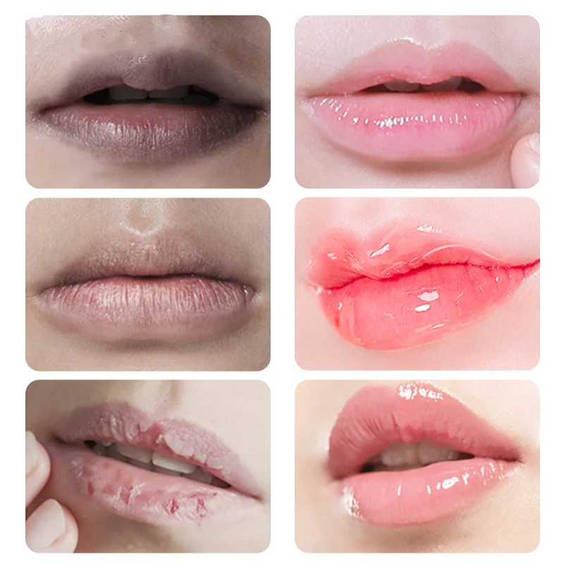 10Pcs שפתיים ורוד סרום טרי להסיר כהה השפתיים ג ' ל בסדר תיקון קו להאיר השפה אקספוליאטור להלבין קרם לחות מזין המהות.