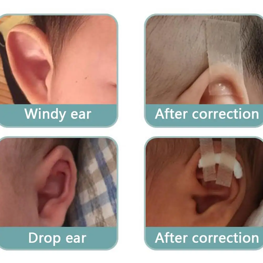 1Roll האוזן אסתטי תיקונים סיליקון הקלטת ילד תינוק תינוק תיקון אוזניים סיליקון רך הקלטת אישי בריאות האוזן אכפת לי